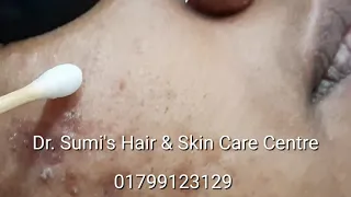 Acne || Acne Scar || Pigmentation || TCA Chemical Peeling || Melasma || Dr. Ummay Habiba Sumi