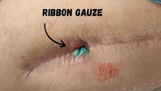 How to drain an abscess? - Use ribbon gauze to heal