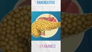 what is pancreatitis?  Overview