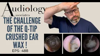 THE CHALLENGE OF THE Q-TIP CRUSHED EAR WAX - EP488