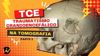 TRAUMATISMO CRANIOENCEFÁLICO / TCE - Tomografia de Crânio no Trauma Parte I