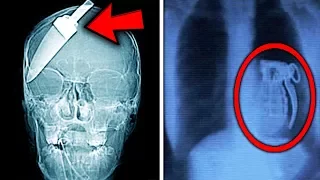 Top 10 Most Shocking THINGS FOUND IN X-RAYS!