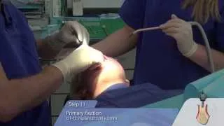 OT medical: OT-F3 Implant-Insertion with Sinus Lift