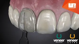 Uveneer® Procedure Animation | Direct Veneer Template System