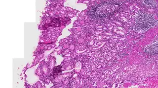 Gastric Ulcer Histologic / Microscopic Diagnosis and Differential