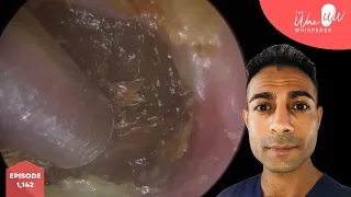 1,142 - Difficult Ear Wax & Keratosis Obturans Removal