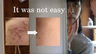 I tried water-only skin care for 2 years and my acne has all gone | Japanese Skin Fasting