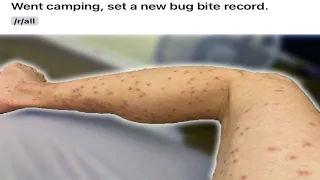r/WellThatSucks | Man Sets New Bug Bite Record, 100+ Bug Bites!