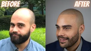 MIND-BLOWING Scalp Micropigmentation Result