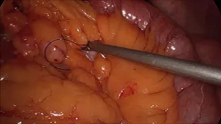 OAGB Mini-gastric bypass mesenteric defect closure