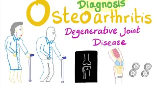 Osteoarthritis (OA) Part 5: Diagnosis