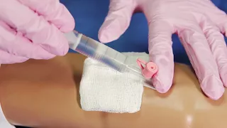 Техника постановки периферического венозного катетера