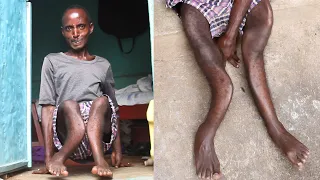 The Incredible Man With Legs Like Scissors | LIVING DIFFERENTLY