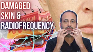 Damaged Skin & Radiofrequency | Dr. Ben Talei | Plastic Surgeon in Beverly Hills