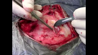 Microsurgical Resection of Trigeminal Schwannoma via Anterior Petrosal Approach