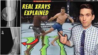 Chris Weidman Shares REAL Xrays of Broken Leg from UFC 261 - Doctor Explains Images