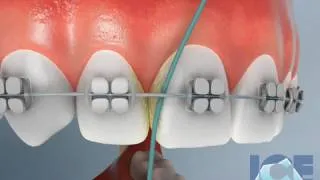 Flossing With Braces