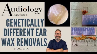 GENETICALLY DIFFERENT EAR WAX REMOVALS - EP513