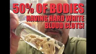 50% of Bodies Have White Blood Clots?