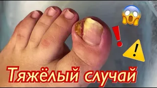 Тяжёлый случай😱❗️⚠️🆘🦶🏻