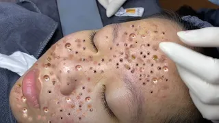 Make your Acne Treatment Huong Da Nang​ | acne 2022 Part9