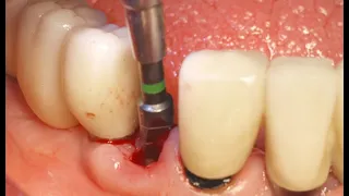 Simple digital work flow in Dental implant prosthesis