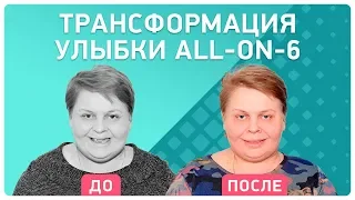 #ТрансформацияУлыбки Елены Молодцовой 👉 как проводится установка имплантов и протезов