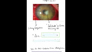 Acute Keratitis (Due to Contact Lens) - Case Discussion In A Minute #Shorts