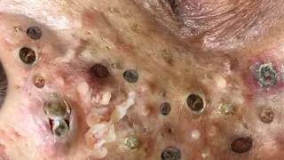 Loan Nguyen Acne spa