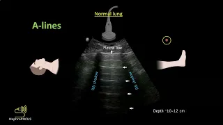 Introduction to lung ultrasound for the nephrologist I Dr. Koratala @NephroP