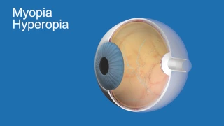 Myopia and Hyperopia