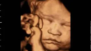 3D ultrasound at 31 weeks GoldenView Ultrasound