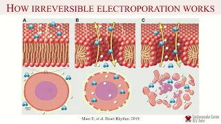 PR2024 - Ablation Of Atrial Fibrilation - April 22, 2024