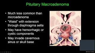 Sellar, Suprasellar and Parasellar Masses w/Dr. Shatzkes 7/21