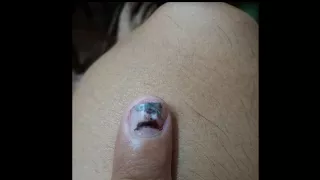 Smashed Nail Time Lapse in 3 Months