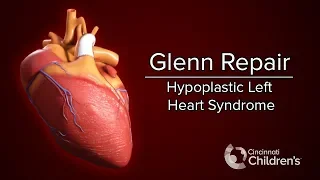 Medical Animation: Glenn Operation | Cincinnati Children's