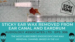 STICKY EARWAX REMOVED FROM EAR CANAL AND EARDRUM - EP 306