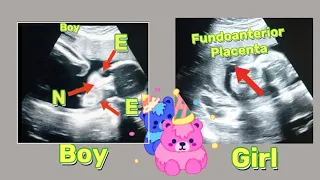 22 wk Fetal heartbeat anomaly ultrasound |  Fundal Anterior placenta means baby boy/girl | pregnancy