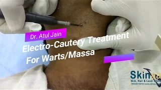 Warts/Mole Removal Treatment with Electrocautery in Jaipur, India – Dr Atul Jain