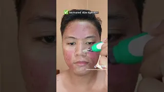 This is  how I treat my Acne Scars, It's super effective! 🥺🥺🥺  |  Dynel Beo