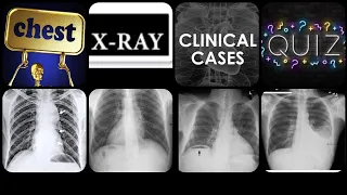 chest x-ray clinical cases quiz | 1-50cases |chest xrays ❤️||chest xrays made simple 👌;x-rays .