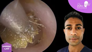 1,255 - Deep Itchy Dead Skin & Ear Wax Removal