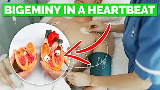 What is BIGEMINY? Causes & Preventions | Cardiac Arrhythmia Explained