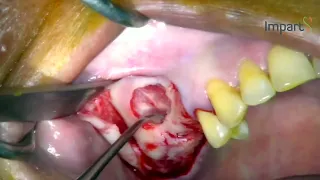 Direct sinus lift: Perforation management