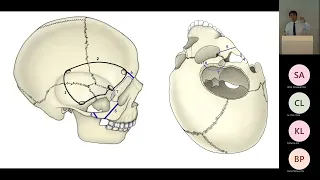 Pediatric Craniopharyngioma Pt.2, Endoscopic Transsphenoidal Approach and Pterional Approach