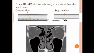 anterior ethmoidal artery overview