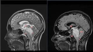 36 year old with nystagmus and vertigo