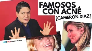 Famosos con acné. Cameron Diaz | Dr. Marino dermatólogo