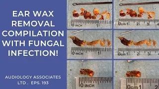 EAR WAX REMOVAL COMPILATION WITH FUNGAL INFECTION - EP193