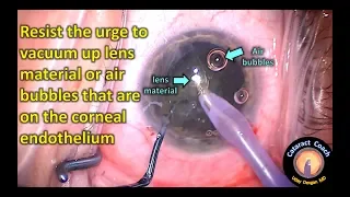 Do not vacuum near the corneal endothelium in cataract surgery
